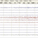 image-content-top_besa-eegfocus-overview
