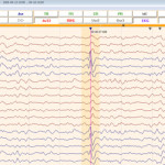image-content-top_besa-epilepsy-features-spike-detection